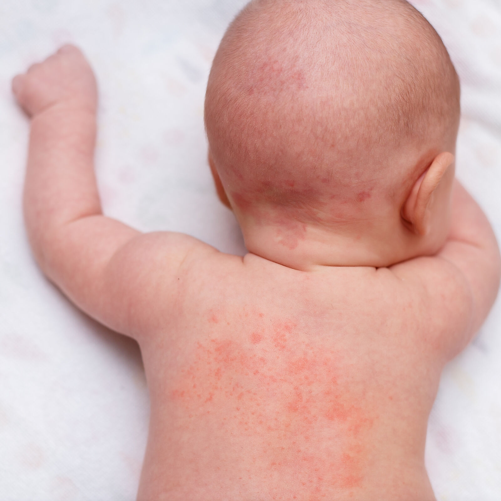How to care for a baby with dermatitis